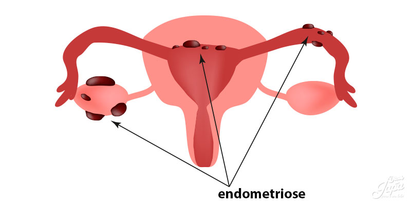 O que é Endometriose